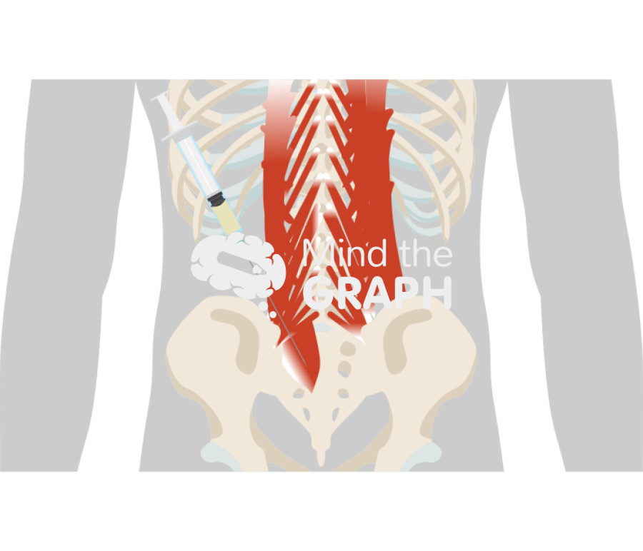 Sacral erector spinae plane block Icons, Symbols, Pictures, and Images